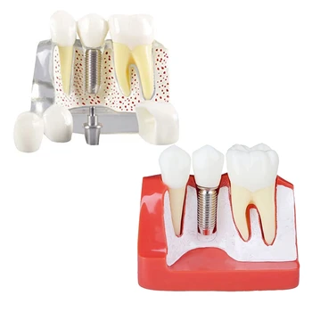 Демонстрационная модель зубов, Съемный имплантат, корончатый мост для анализа, общение с пациентом